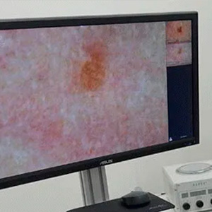 Цифровая дерматоскопия РДС-3