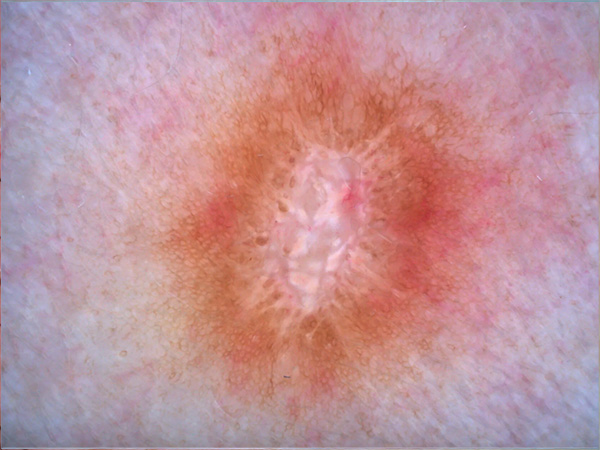 Дерматоскопия РДС-3 в Медицинском центре Никсор