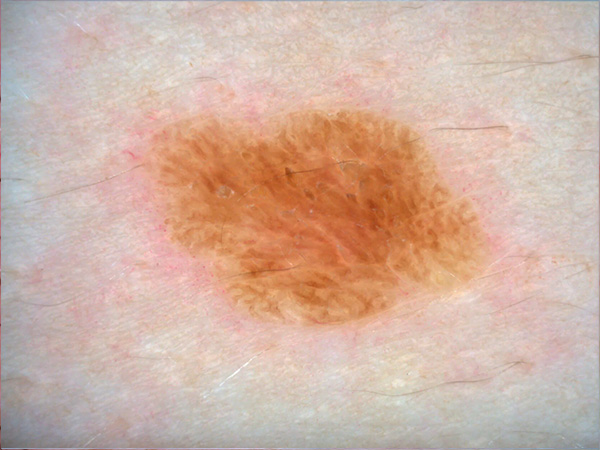 Дерматоскопия РДС-3 в Медицинском центре Никсор