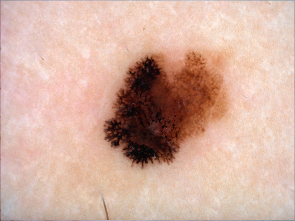 Дерматоскопия РДС-3 в Медицинском центре Никсор